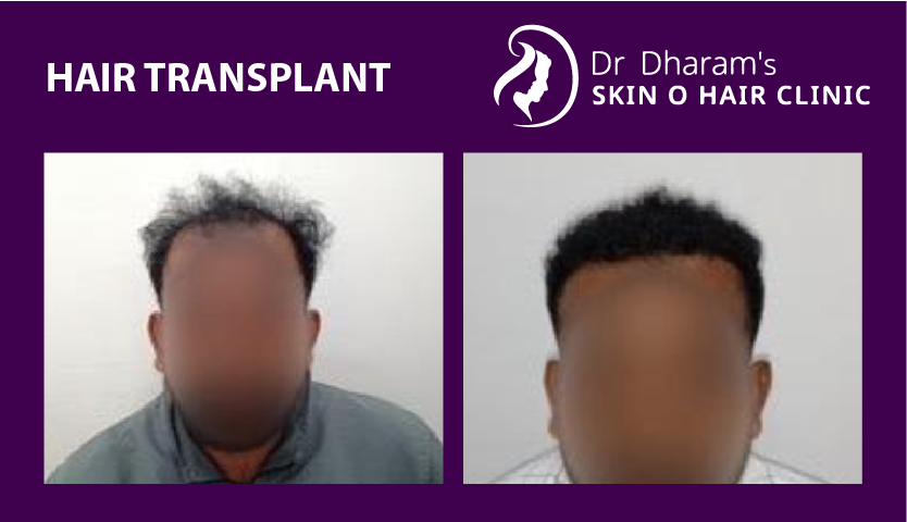 hair-transplantba4