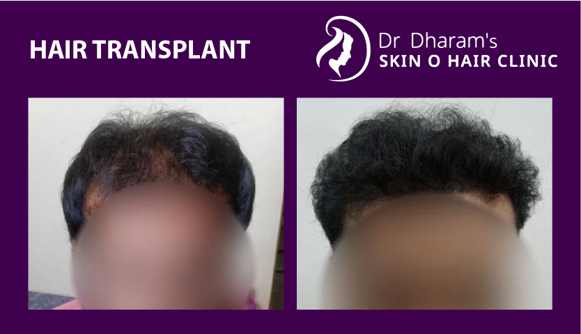 hair-transplantba6