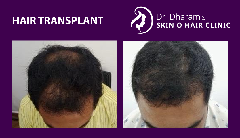hair-transplantba9