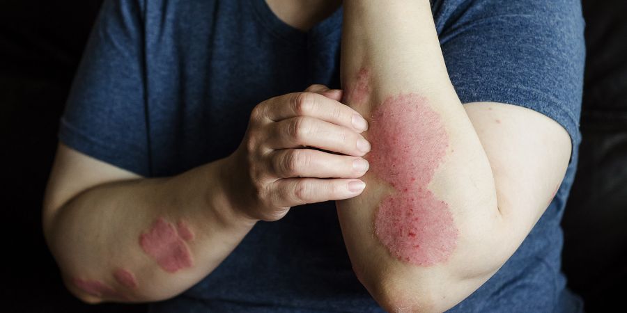 FAQs on Psoriasis: Can Psoriasis Be Prevented? | Dr. K.C. Dharam Kumar