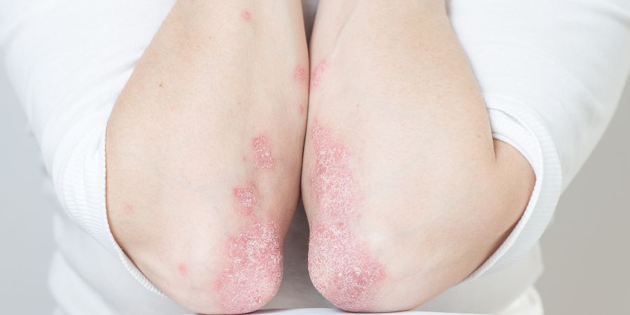 Best Dermatologists in BTM Layout | Dr. K C Dharam Kumar