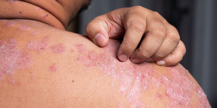 How Stress Impacts Psoriasis – And Why Managing It Matters