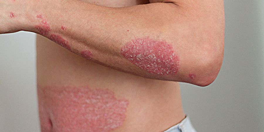 Understanding Psoriasis: Causes, Symptoms & Treatment Options | Skin Doctor in BTM Layout | Dr. K C Dharam Kumar