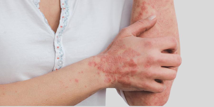 How Psoriasis Affects Your Skin and Overall Health | Psoriasis Treatment by Dr. K C Dharam Kumar