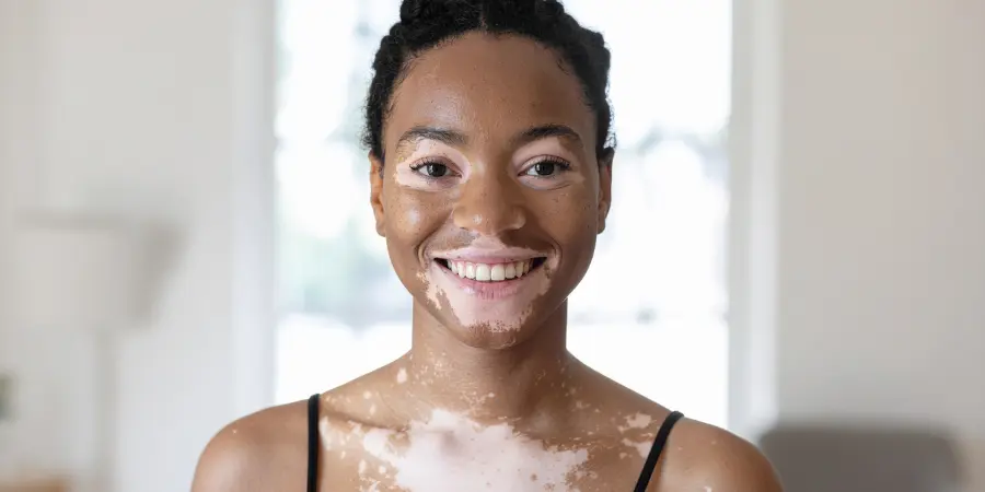 What Is Vitiligo and Its Causes | Best Dermatology Centres in BTM Layout | Dr. K. C. Dharam Kumar