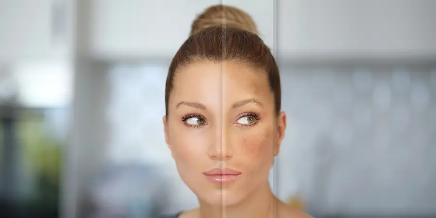 Hyperpigmentation and Its Causes | Best Dermatologist in BTM Layout | Dr KC Dharam Kumar