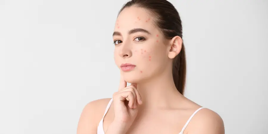 Causes of Back Acne | Best Dermatologist in BTM Layout