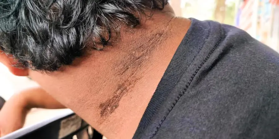Acanthosis Nigricans (Pigmentation): Causes, Symptoms & Effective Treatment Options | Best Dermatologists In BTM Layout