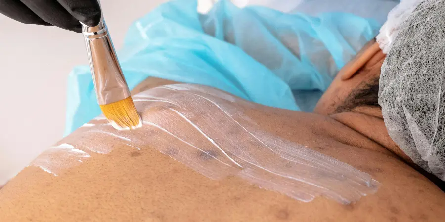 Chemical Peels for Acne Scars: Benefits, Risks & Results | Chemical Peeling Treatment in BTM Layout