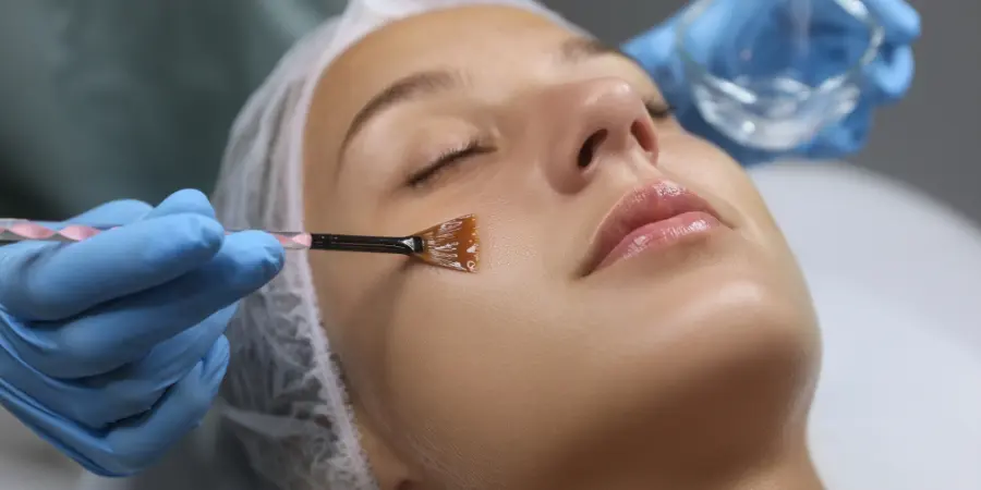 Chemical Peel for Dark Spots: Results and Expectations | Skin Clinics in Bangalore