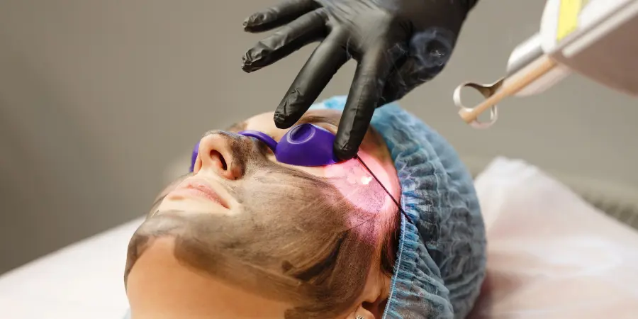 Is Carbon Laser Peel Safe for Indian Skin Tones? | Carbon Laser Peel Treatment in BTM Layout