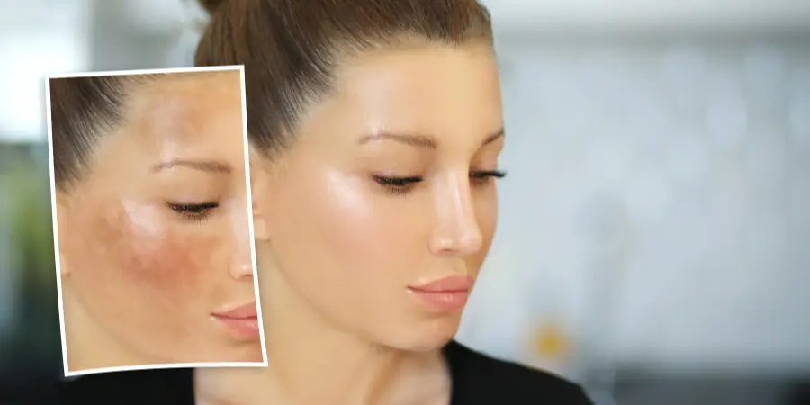 Treatment Options for Pigmentation: Understanding Melasma and How to Manage It | Dermatologist BTM Layout
