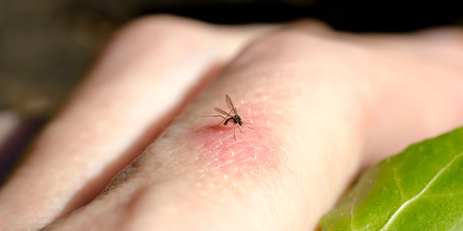Why Do Mosquito Bites Look So Big in Kids? | Dermatologist near BTM Layout