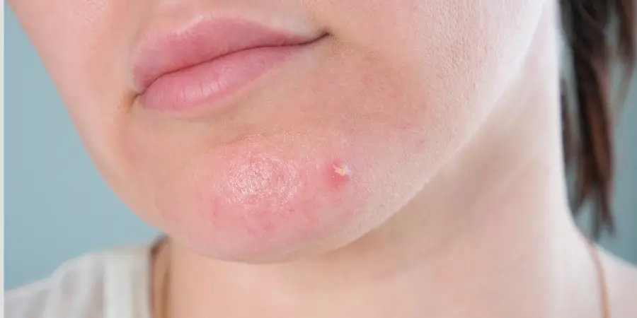 One Pimple, Months of Marks: The Science Behind Indian Skin | Acne Treatment BTM Layout