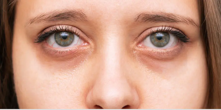 What Type of Dark Circles Do You Have? Causes & Solutions | best dermatologist in BTM Layout 