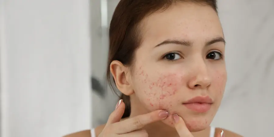 Why Is Acne Not Getting Better? Possible Causes and Solutions | Acne scar removal in BTM Layout