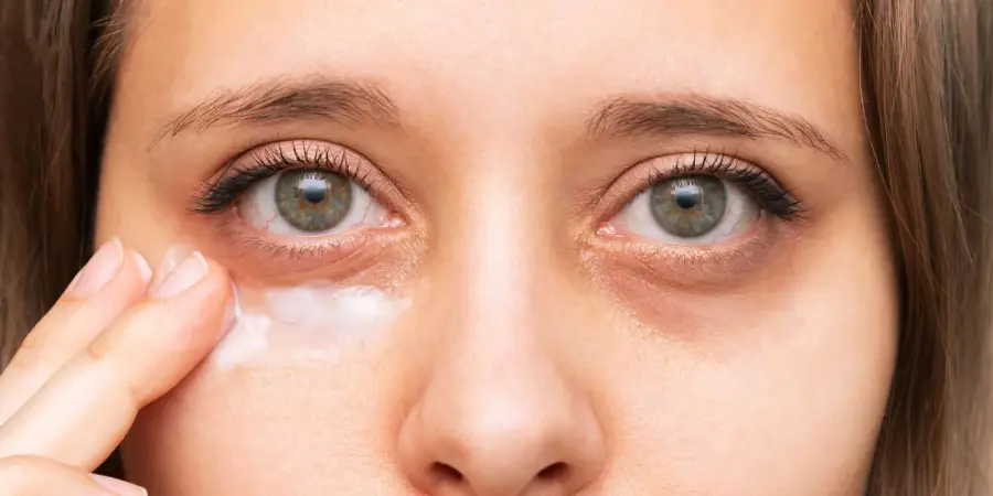 Under-Eye Pigmentation: Causes, Prevention, and Treatment Options | Dermatologist in BTM Layout